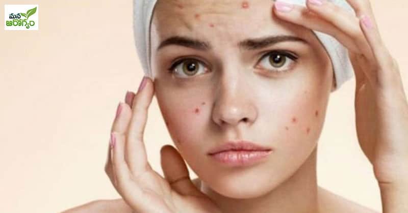 Easy home tips to get rid of pimples
