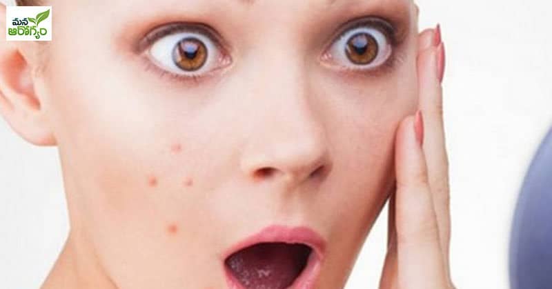 Easy home tips to get rid of pimples
