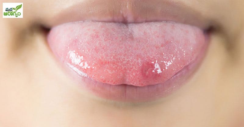 causes of mouth sores