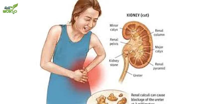 tips to reduce kidney stones?