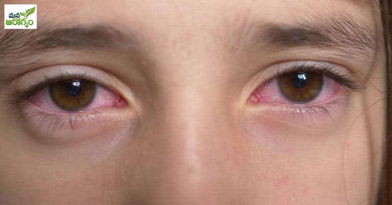 What causes redness of the eyes