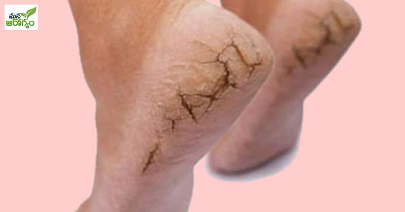 Home Tips for Reducing Foot Cracks