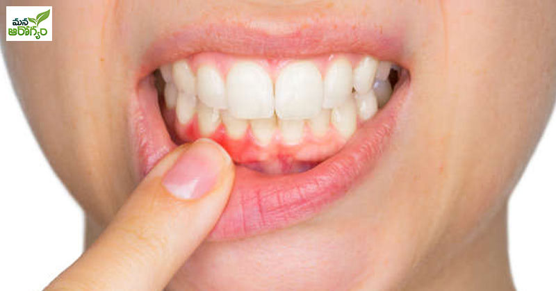 reduce Gums Swelling
