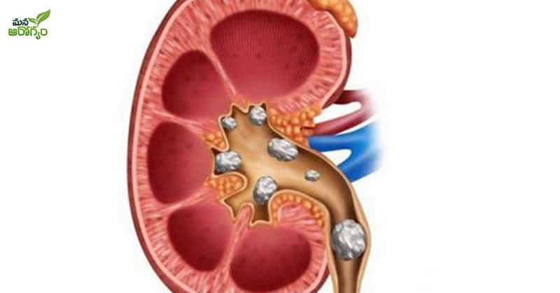 Symptoms of kidney stones