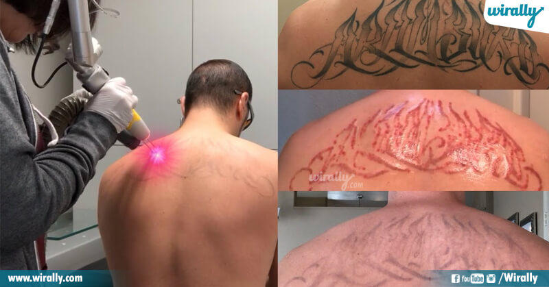 Tattoo Removal: 10 Effective Ways To Remove Your Permanent Tattoo At Home -  Wirally