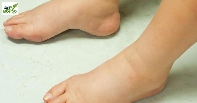 Problems Caused By Swelling In The Legs