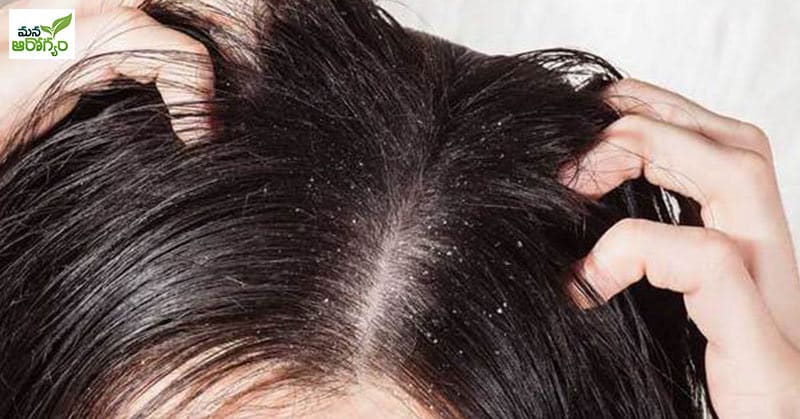 dandruff and hairfall